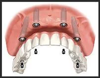 Denture Support